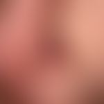 Lupus erythematodes chronicus discoides:&nbsp;unscharf begrenzte, rote und braune, teils schuppen...