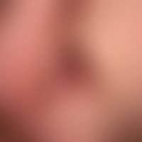 Lupus erythematodes chronicus discoides:&nbsp;unscharf begrenzte, rote und braune, teils schuppen...