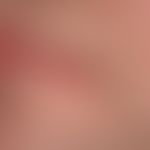 Chronische Cheilitis bei Lupus erythematodes chronicus discoides: chronisch aktive, rote, hyperäs...
