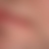 Chronic cheilitis in lupus erythematosus chronicus discoides: chronically active, red, hyperesthe...