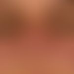 Lupus erythematodes chronicus discoides: bereits langzeitig bestehende, unscharf begrenzte, rote,...