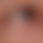 Chronische (vernarbende) Blepharitis bei Lupus erythematodes chronicus discoides: chronisch aktiv...