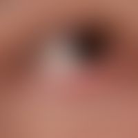 Chronic (scarring) blepharitis in lupus erythematosus chronicus discoides: chronically active, re...