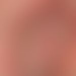 Candidose intertriginöse: ungewöhnliche pustulöse Candidose bei bettlägrigem immungeschwächtem Pa...