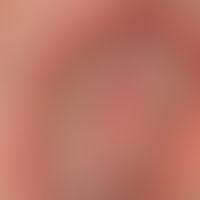 Candidose intertriginöse: ungewöhnliche pustulöse Candidose bei bettlägrigem immungeschwächtem Pa...