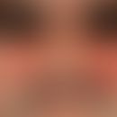 Erysipel akutes: akut aufgetretene, seit 4 Tagen bestehende, zunehmende, glatte, flächenhafte, sc...