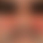 differential diagnosis "lupus erythematosus acute-cutaneous" : acute erysipelas. acutely appeared...