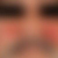 differential diagnosis "lupus erythematosus acute-cutaneous" : acute erysipelas. acutely appeared...