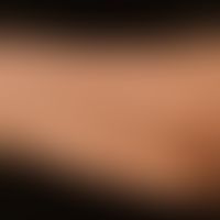 Poikilodermie: chronische Graft- versus Host-Disease mit bunscheckigen, hyper- und depigmentierte...