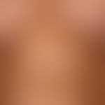 generalized cGVHD: generalized, scleroderma-like, hardly itchy generalized skin disease. graft-ve...