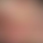 Hyperplastische aktinische Keratose, Auflichtmikroskopie
