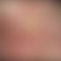 Hyperplastische aktinische Keratose, Auflichtmikroskopie
