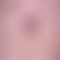 Nodules, flat raised, firm consistency: Dermatofibroma: long-standing, no longer growing, occasio...