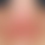 Lichtdermatose, polymorphe: multiple, juckende, hochrote urtikarielle Papeln, teilweise zu großfl...