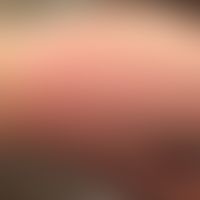 Light dermatosis, polymorphic: multiple, itchy, papules, occasionally also vesicles with simultan...
