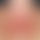 Lichtdermatose polymorphe: akut aufvgetretene Dermatitis wenige Stunden nach erster UV-Bestrahlun...