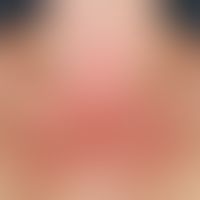 Lichtdermatose polymorphe: akut aufvgetretene Dermatitis wenige Stunden nach erster UV-Bestrahlun...