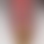 Onychogrypose: krümelige Onychodystrophie mit exzssiver Verdickung des Fingernagels. Vorbekannte,...