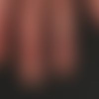 Pincer-nails: chronische kontaktallergische Dermatitis mit kontinuierlicher Ausbildung von Zangen...