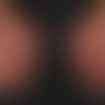 Kontaktdermatitis, toxische: Rötung, Schwellung, Schuppenbidung, Erosionen, Rhagaden Juckreiz und...