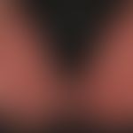 Kontaktdermatitis, toxische: Rötung, Schwellung, Schuppenbidung, Erosionen, Rhagaden Juckreiz und...