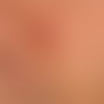 Lymphomatoid papulosis: Previous recurrent clinical picture in a 34-year-old female patient. Rapi...
