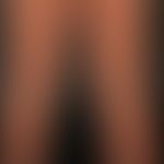 Lymphomatoid papulosis: chronic, relapsing, completely asymptomatic clinical picture with multipl...