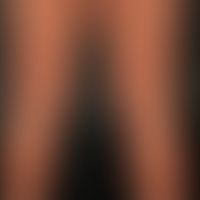 Lymphomatoid papulosis: chronic, relapsing, completely asymptomatic clinical picture with multipl...