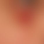 lymphomatoid papulosis: previously known recurrent clinical picture in a 34-year-old female patie...