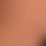 Lymphomatoid papulosis: chronic, relapsing, completely asymptomatic clinical picture with multipl...
