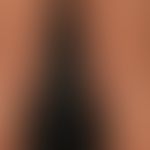 Lymphomatoid papulosis: chronic, relapsing, completely asymptomatic clinical picture with multipl...