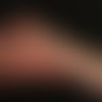 Klippel-Trénaunay syndrome: extensive vascular malformation with extensive nevus flammeus affecti...
