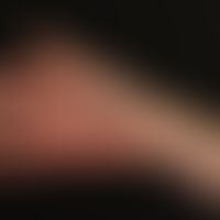 Klippel-Trénaunay-Syndrom:&nbsp;ausgedehnte vaskuläre Malformation mit großflächigem, den Stamm u...