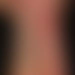 Klippel-Trénaunay syndrome: extensive vascular malformation with extensive nevus flammeus affecti...