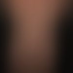 Klippel-Trénaunay syndrome: extensive vascular malformation with extensive nevus flammeus affecti...