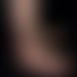 Klippel-Trénaunay syndrome: extensive vascular malformation with extensive nevus flammeus affecti...