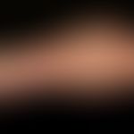Klippel-Trénaunay syndrome: extensive vascular malformation with extensive nevus flammeus affecti...