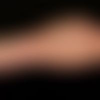 Klippel-Trénaunay-Syndrom:&nbsp;ausgedehnte vaskuläre Malformation mit großflächigem, den Stamm u...