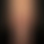 Klippel-Trénaunay syndrome: extensive vascular malformation with extensive nevus flammeus affecti...