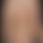 Klippel-Trénaunay syndrome: extensive vascular malformation with extensive nevus flammeus affecti...