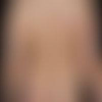 Klippel-Trénaunay syndrome: extensive vascular malformation with extensive nevus flammeus affecti...