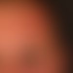 Naevus flammeus (Portwine stain): unscharf begrenzter roter Gefäßnaevus an Stirn (Ausbreitungsgeb...
