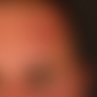 Naevus flammeus (Portwine stain): unscharf begrenzter roter Gefäßnaevus an Stirn (Ausbreitungsgeb...