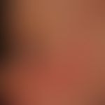 Naevus flammeus (Portwine stain):&nbsp;kongenitale, in V2-Verteilung lokalsierte,&nbsp;völlig sym...