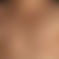 Acne vulgaris: numerous follicular inflammatory papules, eroded and ulcerated papules, scars and ...