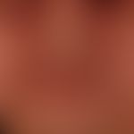 Airborne Contact Dermatitis (Therapieverlauf):&nbsp; Die 54-Jahre alte Floristin bemerkte bereits...