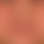 Airborne Contact Dermatitis: weitgehende Abehilung nach interner und externer Therapie mit Glucoc...
