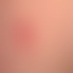 Drug reaction fixed: red, sharply defined, little itchy plaques that have been present for severa...