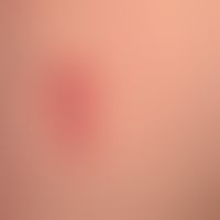 Arzneimittelreaktion fixe: seit mehreren Tagen bestehende, rote, scharf begrenzte, wenig juckende...