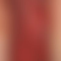 Arzneimittelreaktion, fixe: akutes, solitäres, zunächst&nbsp;tiefrotes schmerzendes Erythem;&nbsp...
